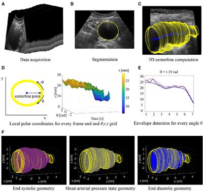 Local and global distensibility assessment of abdominal aortic aneurysms in vivo from probe tracked 2D ultrasound images